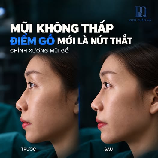 Mũi không thấp nhưng chỉ một điểm gồ làm góc nghiêng thiếu mềm mại: Giải pháp từ Viện thẩm mỹ DrQ